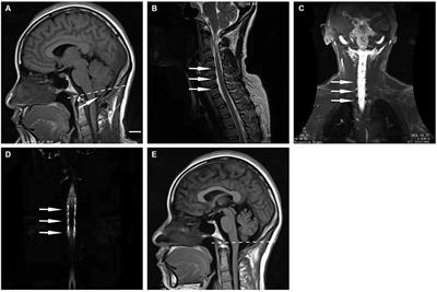 Acquired tonsillar herniation related to spontaneous intracranial hypotension: case reports